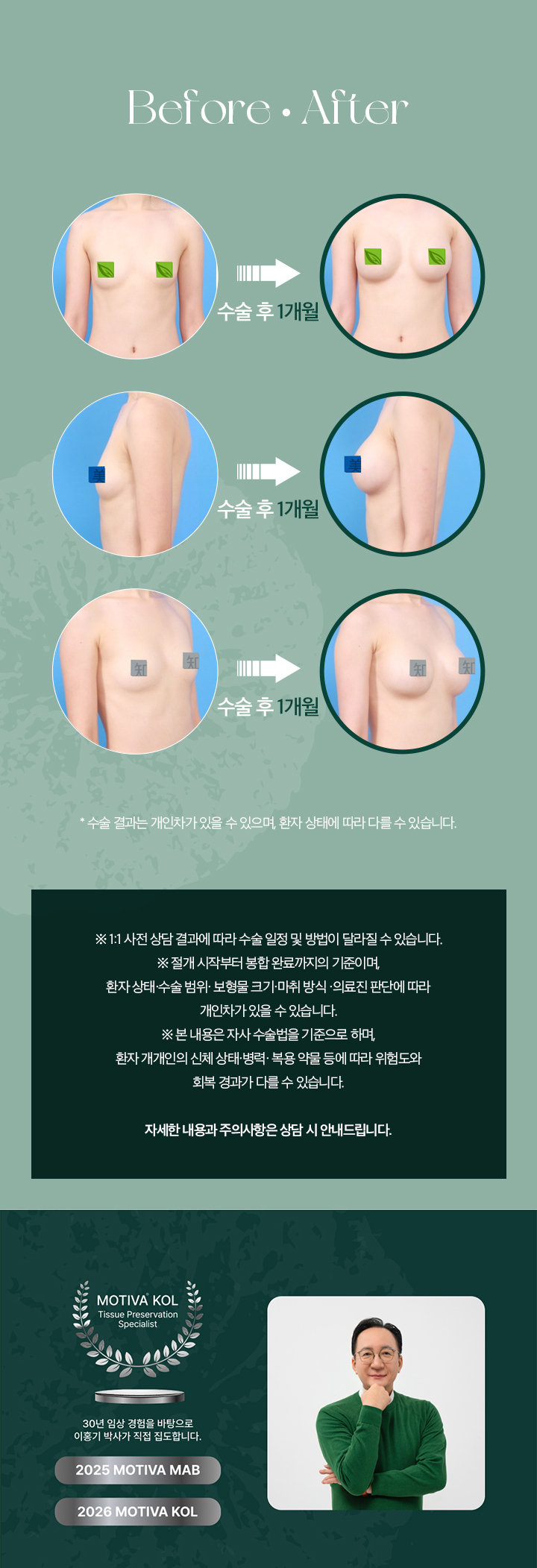 프리저베 가슴성형 mo04