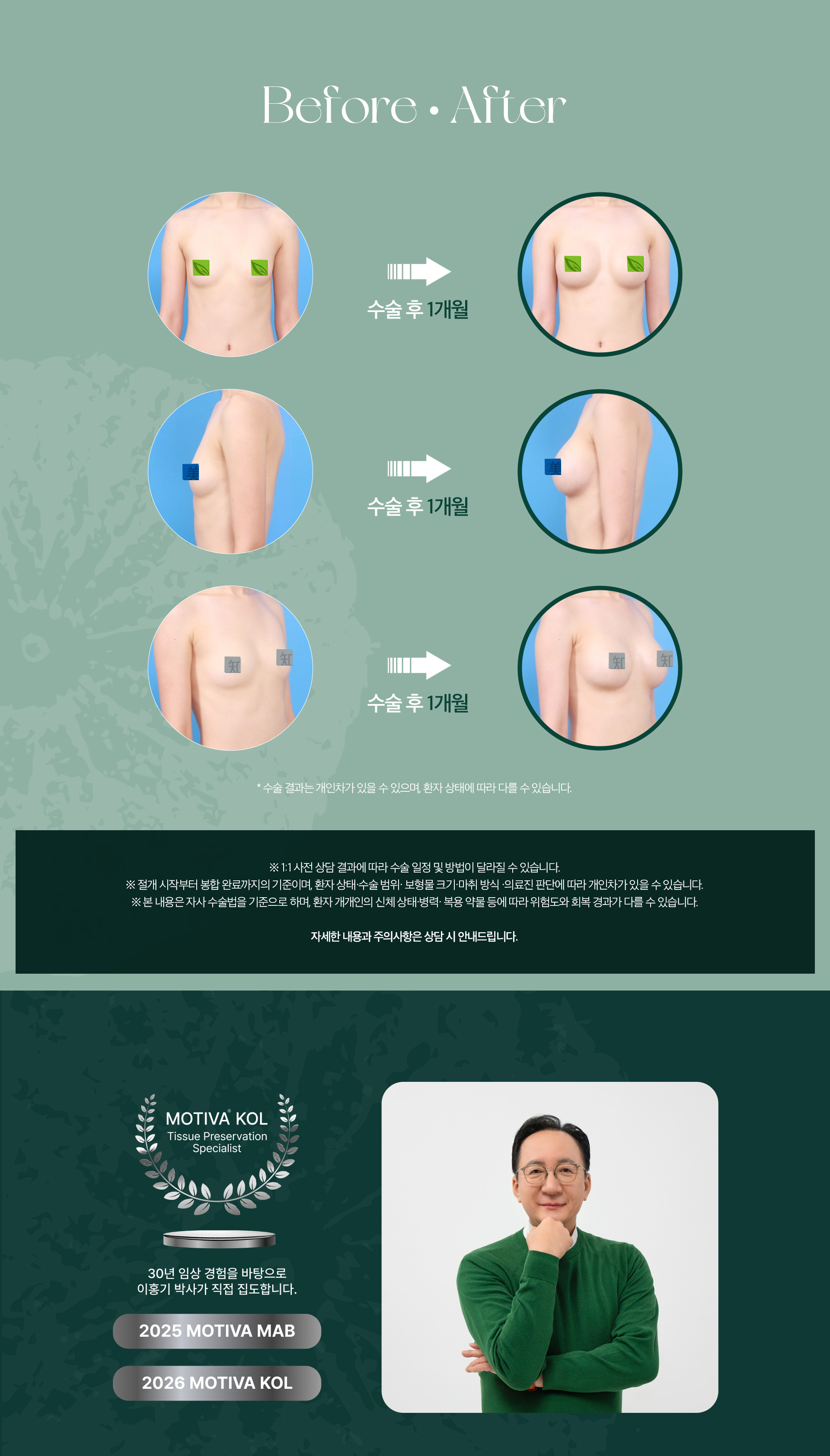 프리저베 가슴성형 pc04